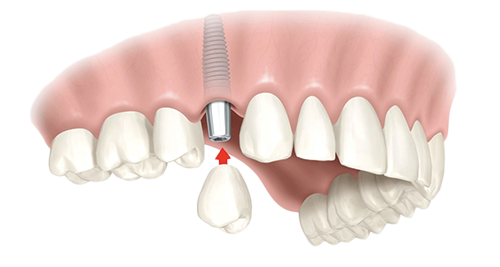Single Dental Implants Summerfield
