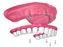 Full Mouth Hybrid Teeth Solutions